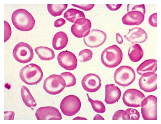 8 de Maio – Dia Internacional da Talassemia