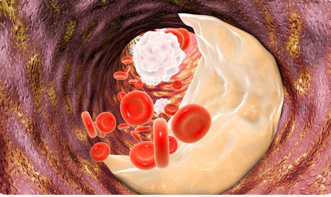 Saiba mais sobre: SBC atualiza diretrizes e torna metas para colesterol ainda mais rigorosas